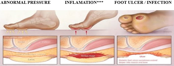 Abnormal pressure inflammation and foot ulcer infection diagram